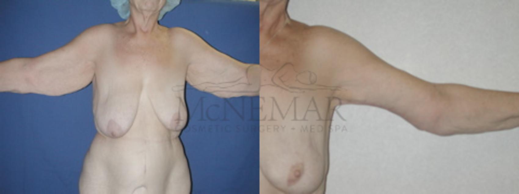 Brachioplasty (Arm Lift) Case 54 Before & After View #1 | Tracy, Brentwood & Livermore, CA | McNemar Cosmetic Surgery