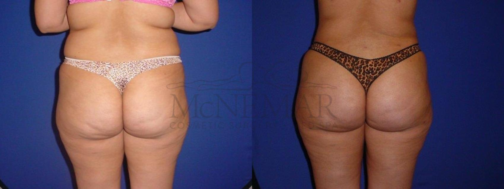Brazilian Butt Lift (BBL) Case 109 Before & After View #1 | Tracy, Brentwood & Livermore, CA | McNemar Cosmetic Surgery