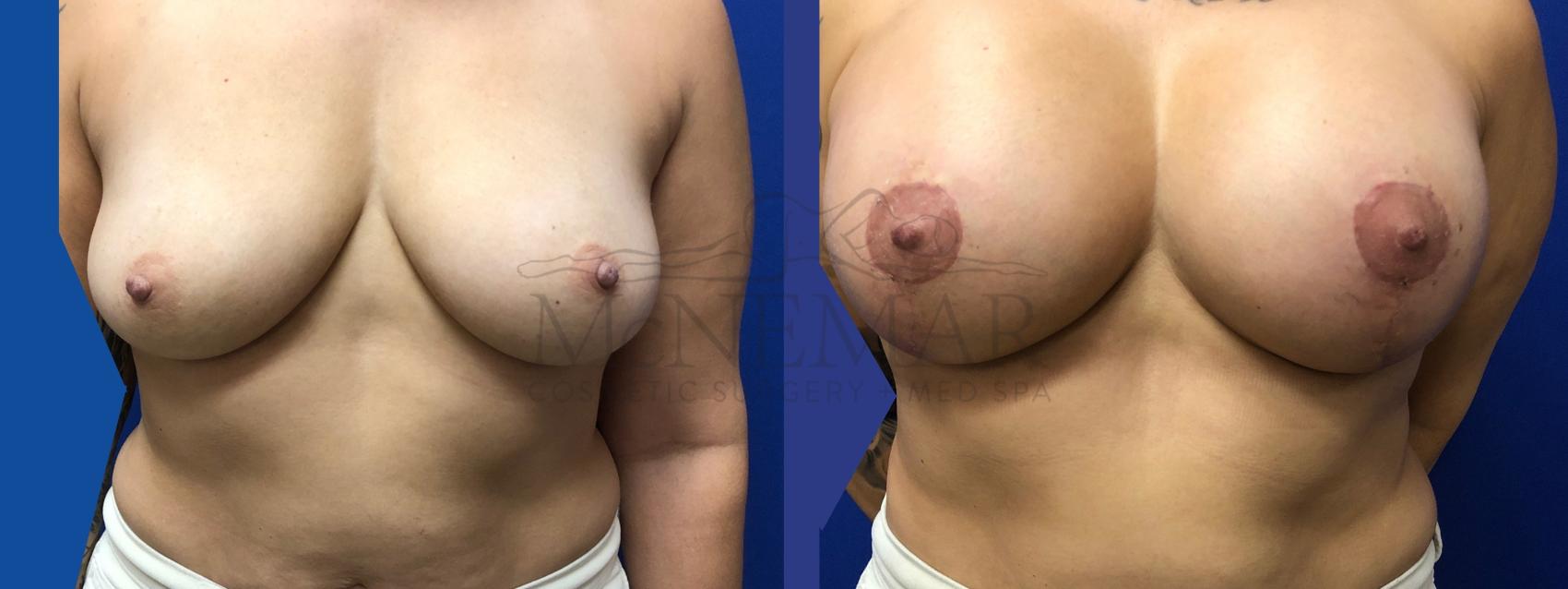 Breast Augmentation Case 127 Before & After Front | Tracy, Brentwood & Livermore, CA | McNemar Cosmetic Surgery