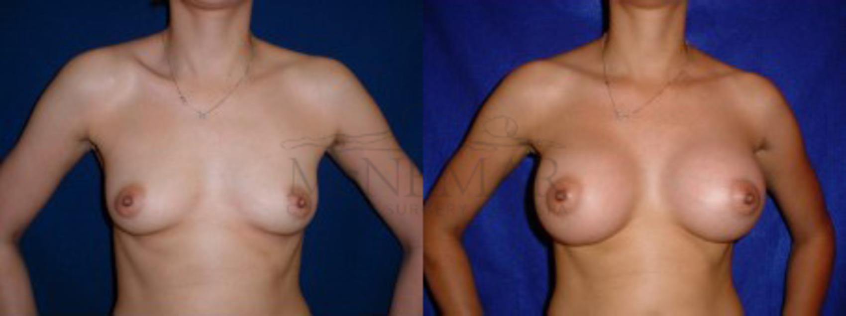 Breast Augmentation Case 2 Before & After View #1 | Tracy, Brentwood & Livermore, CA | McNemar Cosmetic Surgery