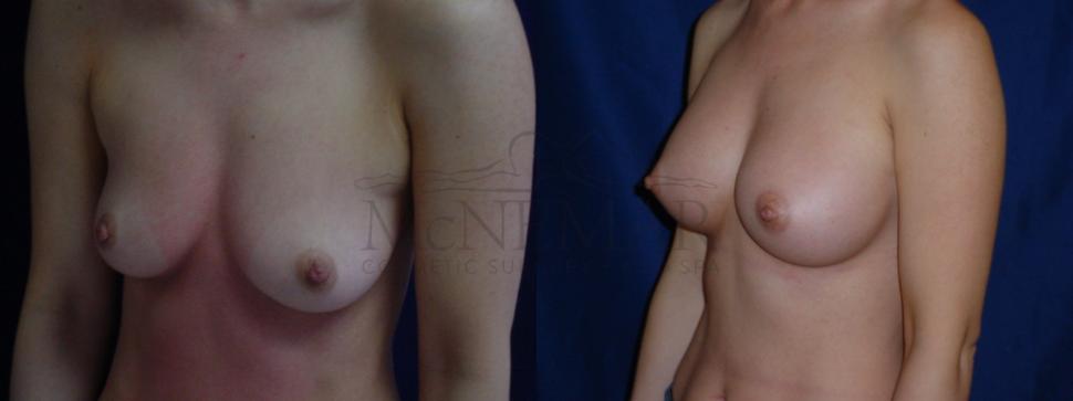 Breast Augmentation Case 31 Before & After View #1 | San Ramon & Tracy, CA | McNemar Cosmetic Surgery