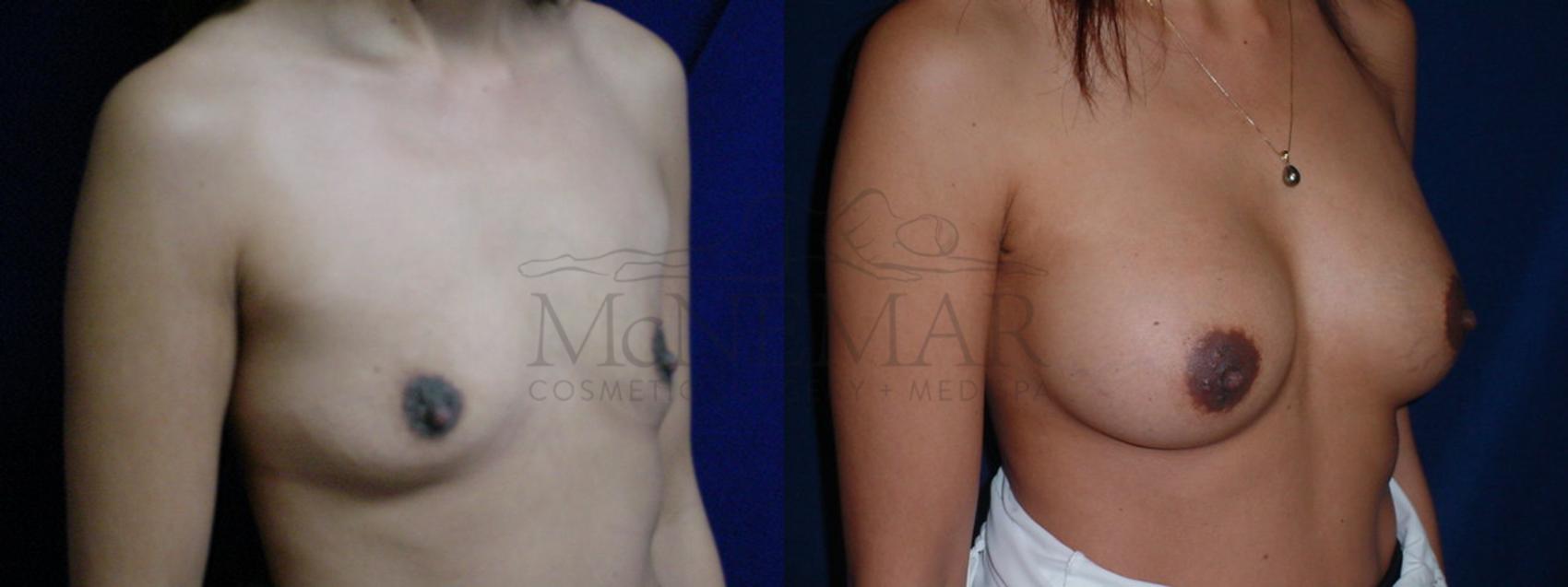 Breast Augmentation Case 36 Before & After View #1 | Tracy, Brentwood & Livermore, CA | McNemar Cosmetic Surgery