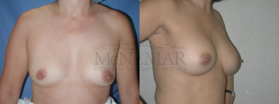 Breast Augmentation Case 53 Before & After View #1 | San Ramon & Tracy, CA | McNemar Cosmetic Surgery