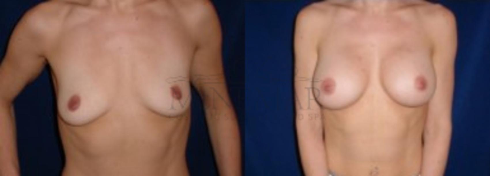 Breast Augmentation Case 7 Before & After View #1 | Tracy, Brentwood & Livermore, CA | McNemar Cosmetic Surgery
