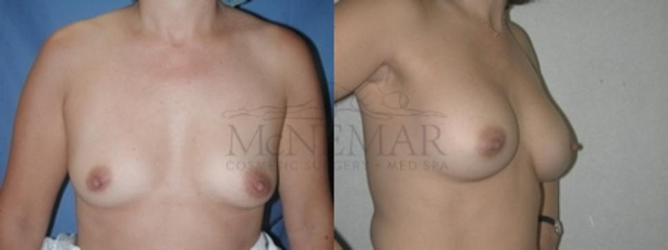 Breast Augmentation Case 80 Before & After Front | San Ramon & Tracy, CA | McNemar Cosmetic Surgery
