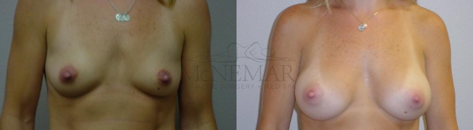 Breast Augmentation Case 88 Before & After View #1 | San Ramon & Tracy, CA | McNemar Cosmetic Surgery