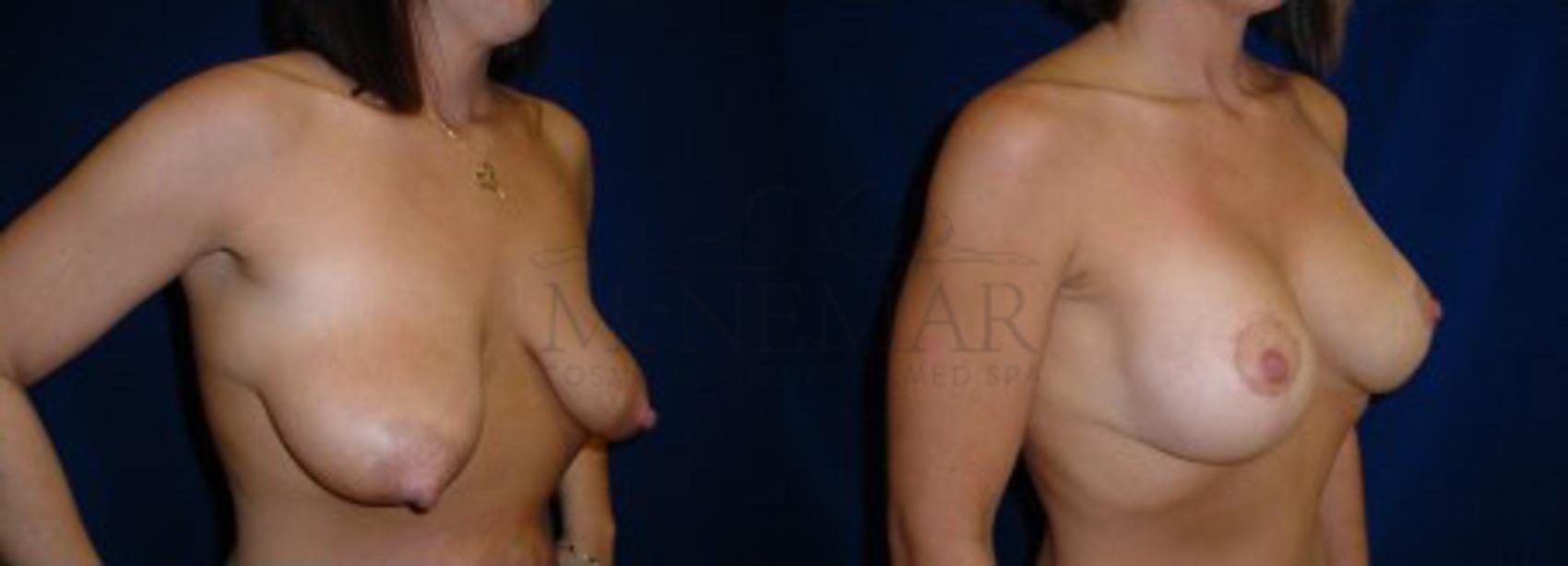 Breast Lift (Mastopexy) Case 16 Before & After View #1 | Tracy, Brentwood & Livermore, CA | McNemar Cosmetic Surgery