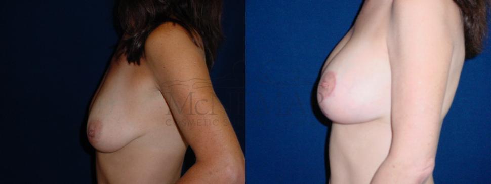 Breast Lift with Augmentation Case 28 Before & After View #1 | San Ramon & Tracy, CA | McNemar Cosmetic Surgery