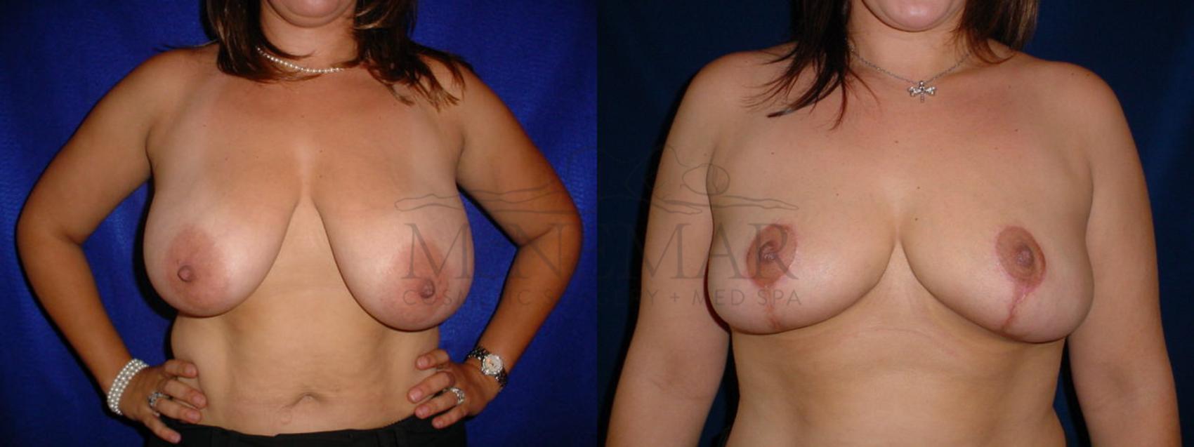 Breast Reduction Case 60 Before & After View #1 | Tracy, Brentwood & Livermore, CA | McNemar Cosmetic Surgery