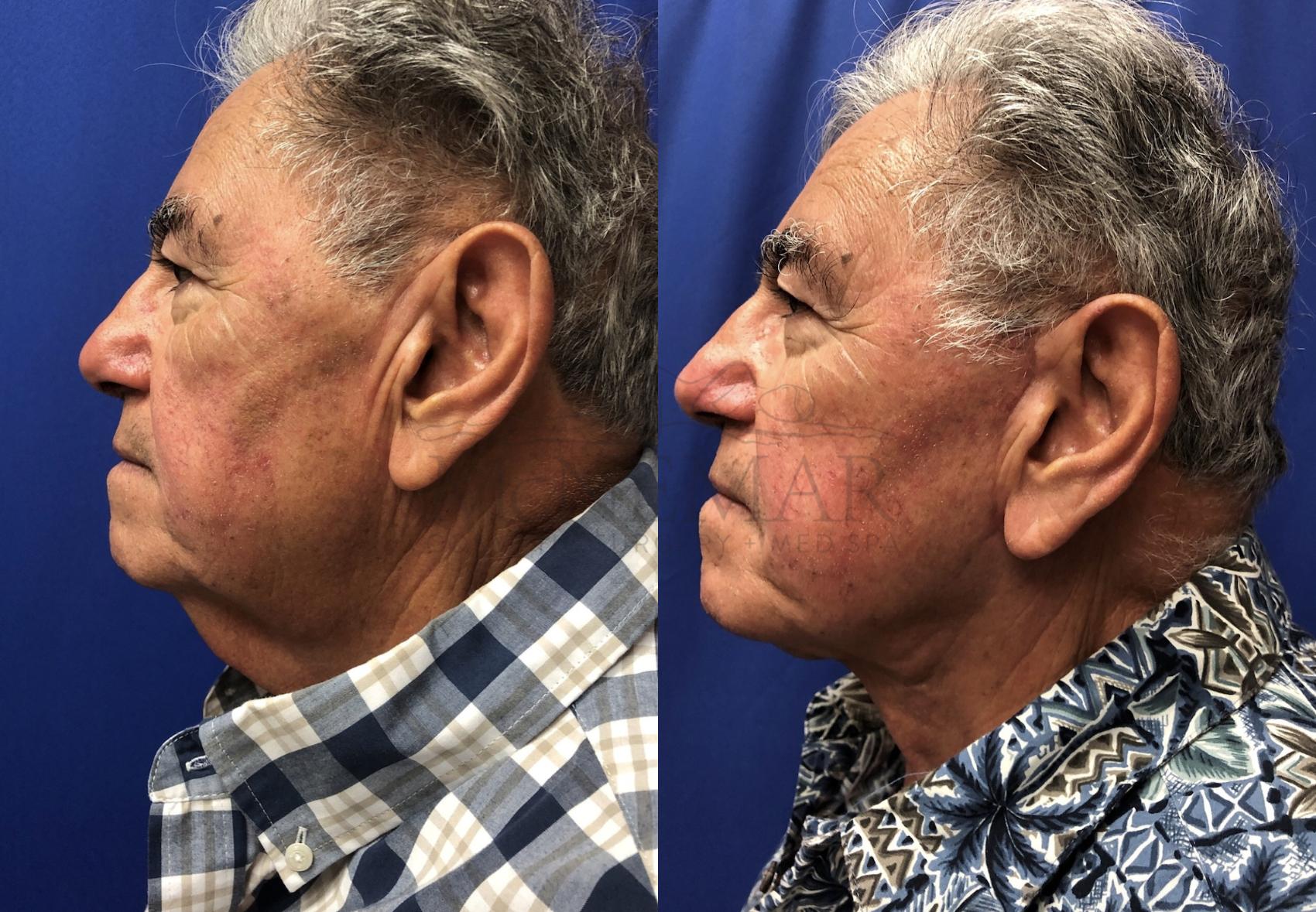 Facelift Case 115 Before & After Left Side | Tracy, Brentwood & Livermore, CA | McNemar Cosmetic Surgery