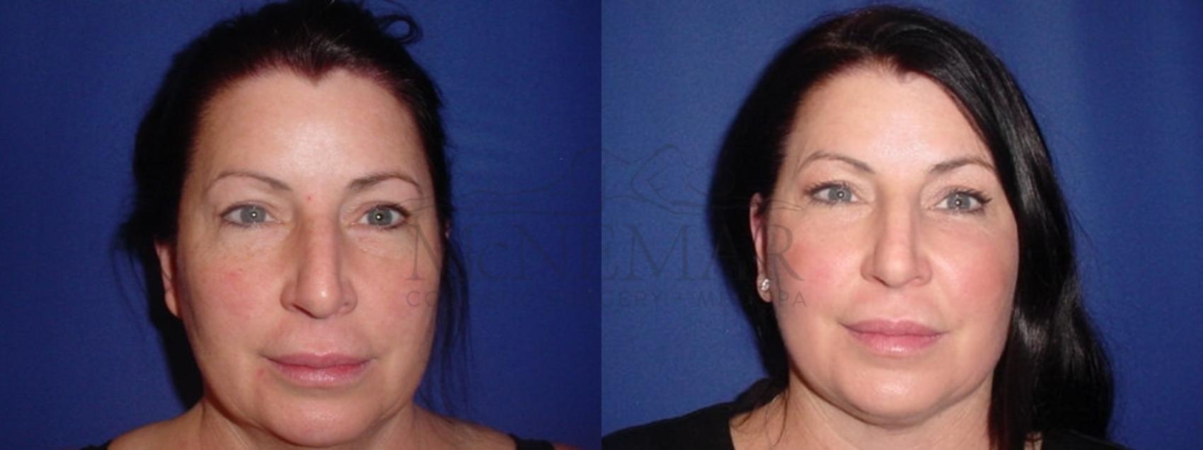 Facelift Case 117 Before & After Front | Tracy, Brentwood & Livermore, CA | McNemar Cosmetic Surgery