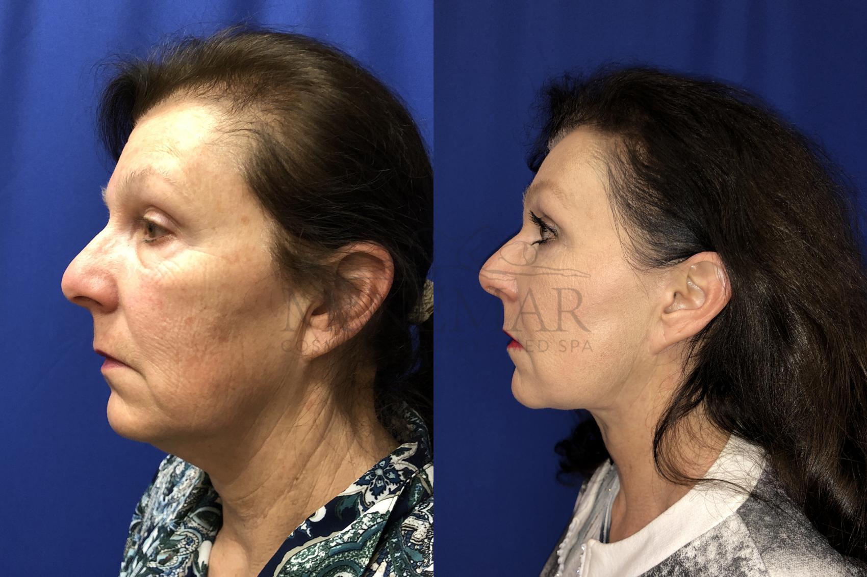 Facelift Case 132 Before & After Right Side | Tracy, Brentwood & Livermore, CA | McNemar Cosmetic Surgery