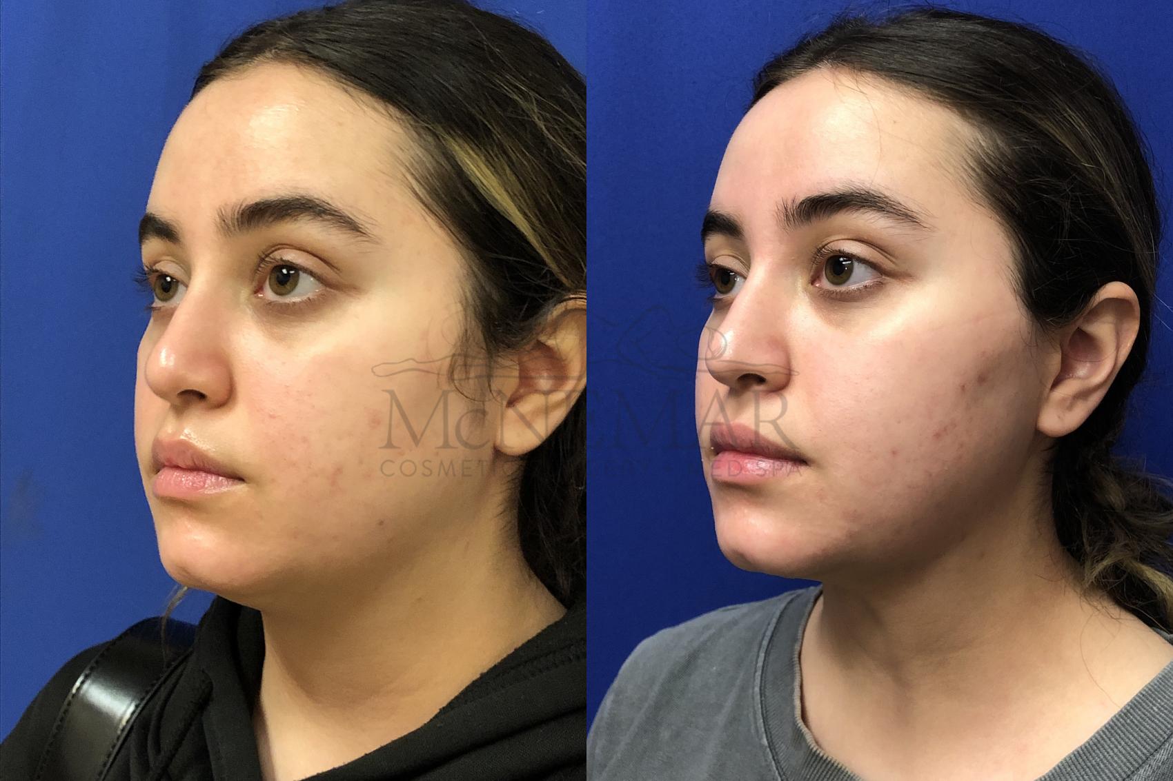 Liposuction Case 144 Before & After Right Oblique | San Ramon & Tracy, CA | McNemar Cosmetic Surgery