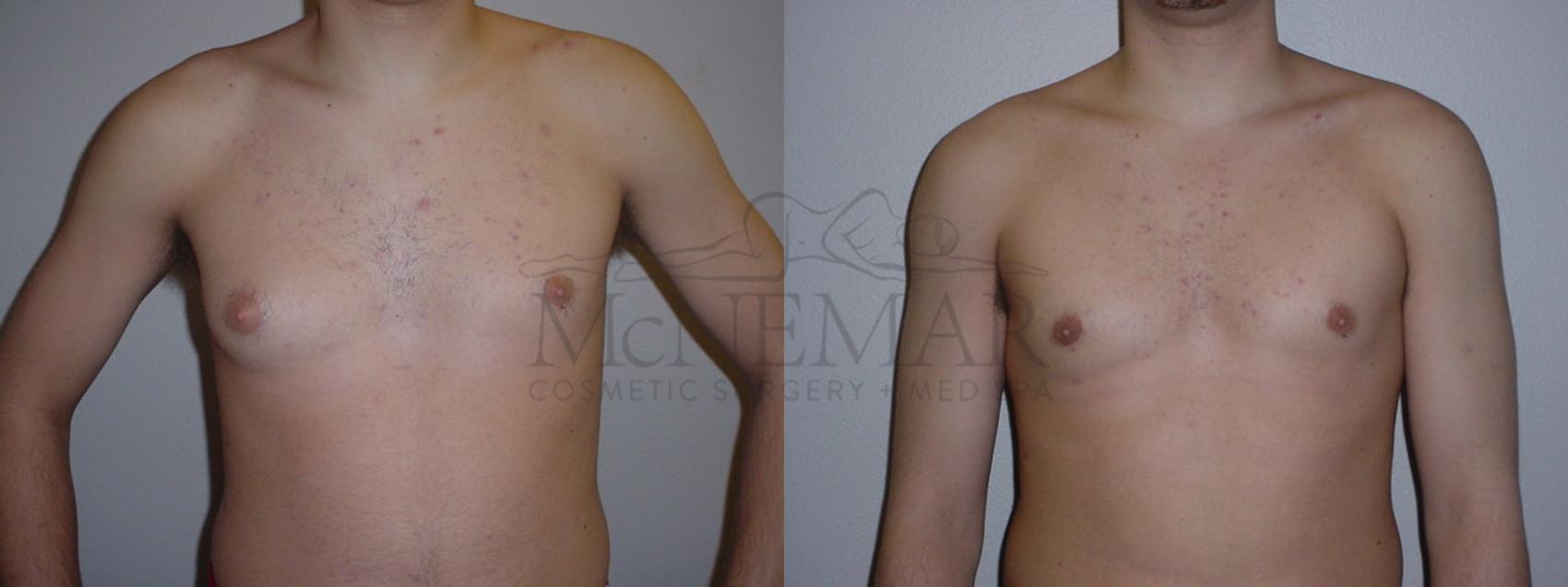 Male Breast Reduction Case 94 Before & After View #1 | Tracy, Brentwood & Livermore, CA | McNemar Cosmetic Surgery