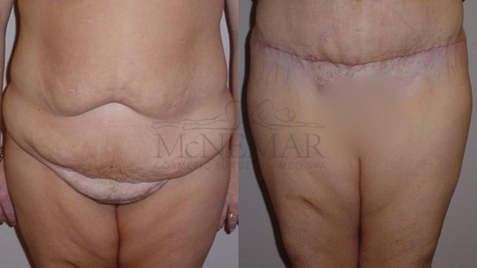 Tummy Tuck (Abdominoplasty) Case 102 Before & After View #1 | San Ramon & Tracy, CA | McNemar Cosmetic Surgery