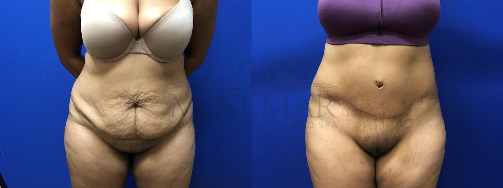 Tummy Tuck (Abdominoplasty) Case 125 Before & After Front | Tracy, Brentwood & Livermore, CA | McNemar Cosmetic Surgery