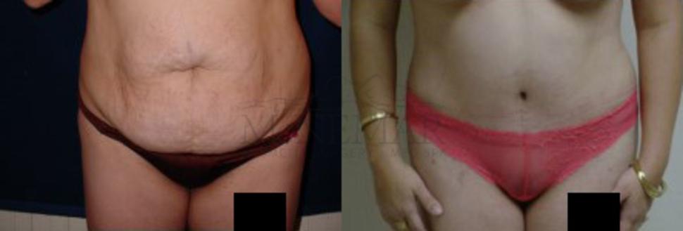 Tummy Tuck (Abdominoplasty) Case 20 Before & After View #1 | San Ramon & Tracy, CA | McNemar Cosmetic Surgery
