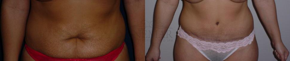 Tummy Tuck (Abdominoplasty) Case 78 Before & After View #1 | San Ramon & Tracy, CA | McNemar Cosmetic Surgery