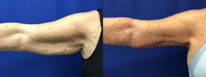 Brachioplasty (Arm Lift) Case 188 Before & After Right Side | Tracy, Brentwood & Livermore, CA | McNemar Cosmetic Surgery