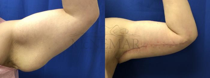 Brachioplasty (Arm Lift) Case 191 Before & After Front | Tracy, Brentwood & Livermore, CA | McNemar Cosmetic Surgery