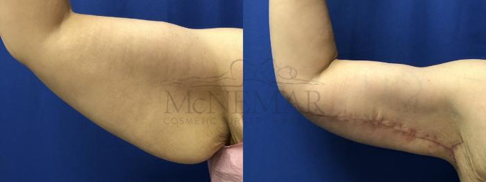 Brachioplasty (Arm Lift) Case 191 Before & After Left Side | Tracy, Brentwood & Livermore, CA | McNemar Cosmetic Surgery