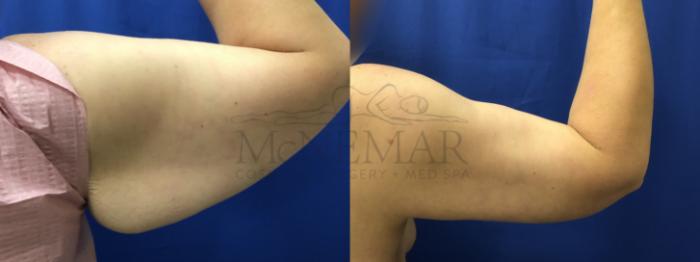 Brachioplasty (Arm Lift) Case 191 Before & After Right Side | Tracy, Brentwood & Livermore, CA | McNemar Cosmetic Surgery