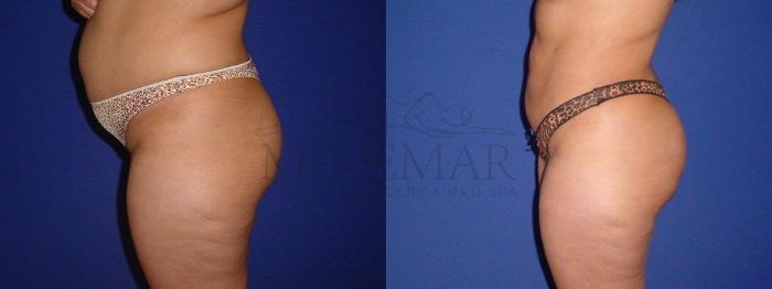 Brazilian Butt Lift (BBL) Case 109 Before & After View #3 | Tracy, Brentwood & Livermore, CA | McNemar Cosmetic Surgery