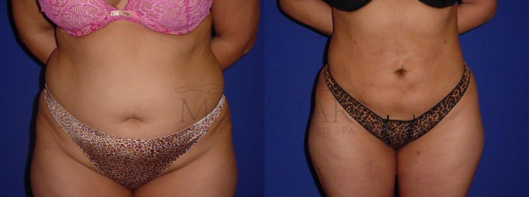 Brazilian Butt Lift (BBL) Case 109 Before & After View #4 | San Ramon & Tracy, CA | McNemar Cosmetic Surgery