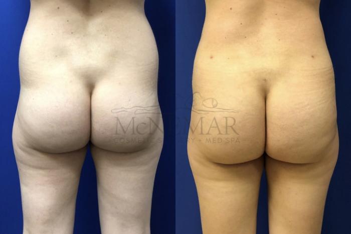 Brazilian Butt Lift (BBL) Case 124 Before & After Back | Tracy, Brentwood & Livermore, CA | McNemar Cosmetic Surgery