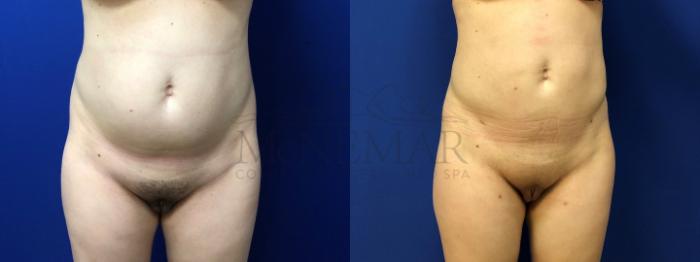 Brazilian Butt Lift (BBL) Case 124 Before & After Front | Tracy, Brentwood & Livermore, CA | McNemar Cosmetic Surgery