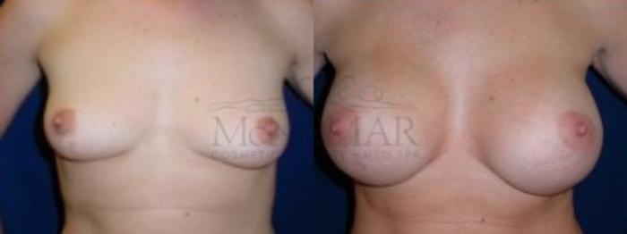 Breast Augmentation Case 1 Before & After View #1 | Tracy, Brentwood & Livermore, CA | McNemar Cosmetic Surgery