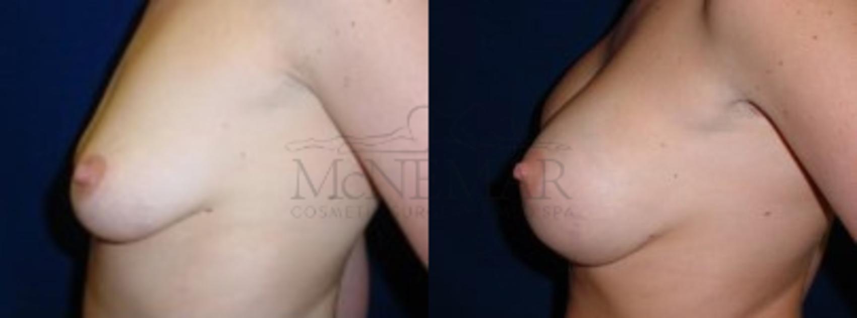 Breast Augmentation Case 1 Before & After View #2 | San Ramon & Tracy, CA | McNemar Cosmetic Surgery