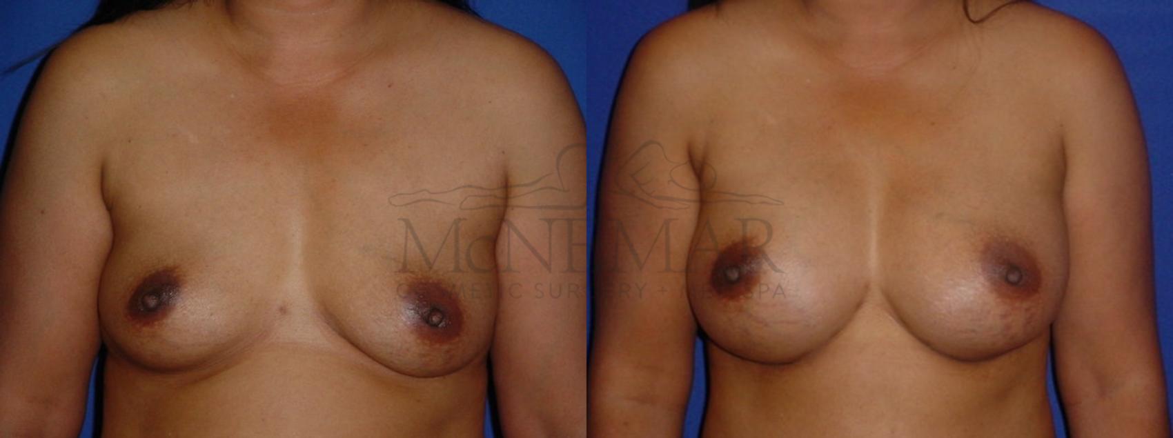 Breast Augmentation Case 111 Before & After View #1 | Tracy, Brentwood & Livermore, CA | McNemar Cosmetic Surgery