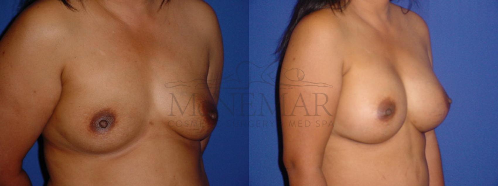 Breast Augmentation Case 111 Before & After View #2 | San Ramon & Tracy, CA | McNemar Cosmetic Surgery