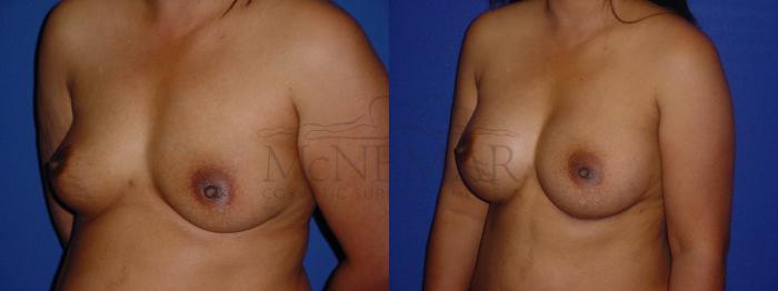 Breast Augmentation Case 111 Before & After View #3 | San Ramon & Tracy, CA | McNemar Cosmetic Surgery