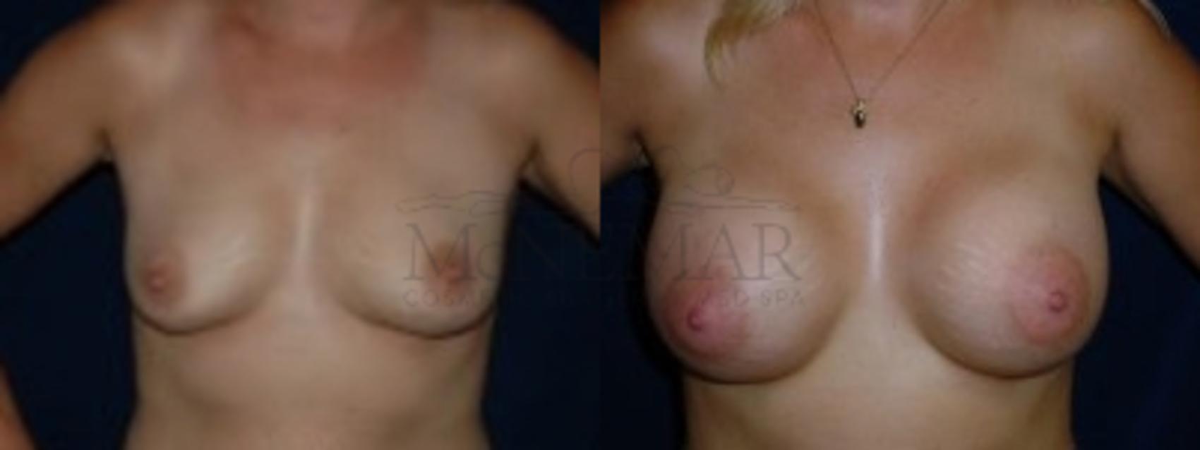 Breast Augmentation Case 113 Before & After Front | San Ramon & Tracy, CA | McNemar Cosmetic Surgery