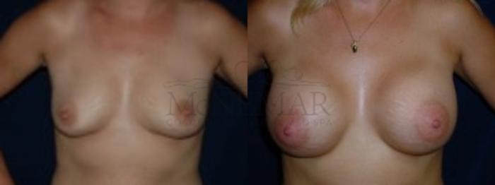 Breast Augmentation Case 113 Before & After Front | Tracy, Brentwood & Livermore, CA | McNemar Cosmetic Surgery
