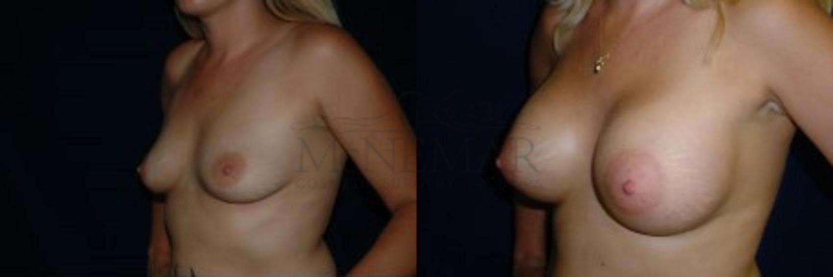 Breast Augmentation Case 113 Before & After Left Oblique | San Ramon & Tracy, CA | McNemar Cosmetic Surgery
