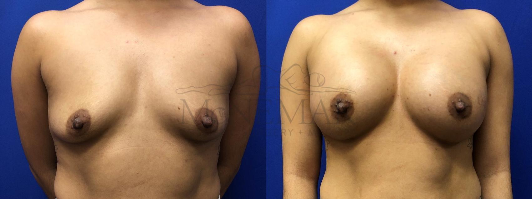 Breast Augmentation Case 123 Before & After Front | San Ramon & Tracy, CA | McNemar Cosmetic Surgery