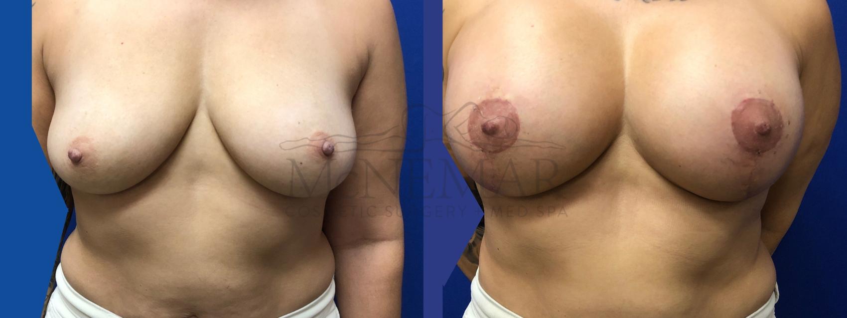 Breast Augmentation Case 127 Before & After Front | San Ramon & Tracy, CA | McNemar Cosmetic Surgery