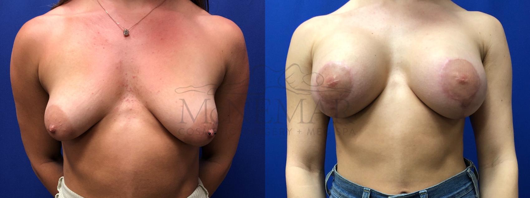 Breast Augmentation Case 128 Before & After Front | San Ramon & Tracy, CA | McNemar Cosmetic Surgery