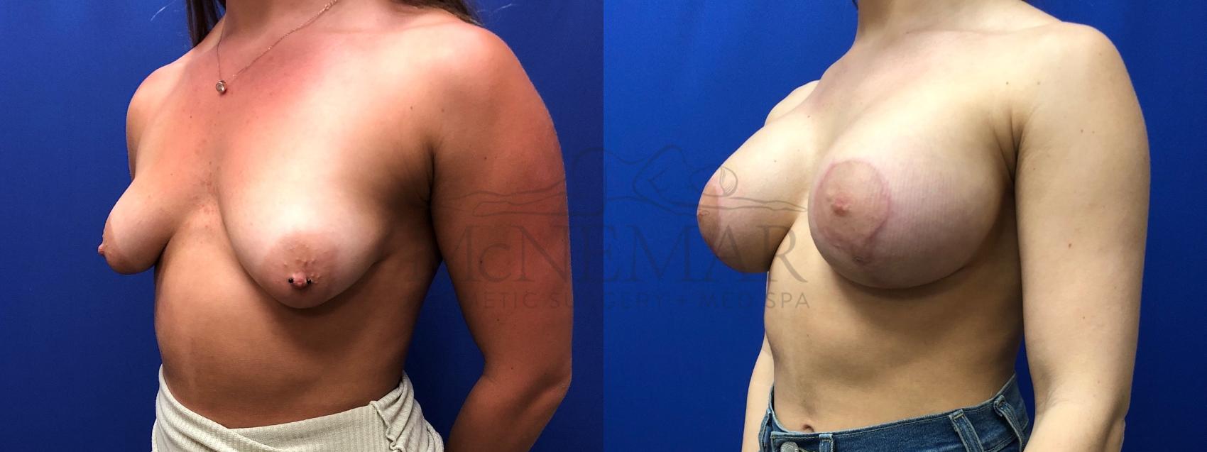 Breast Augmentation Case 128 Before & After Right Oblique | San Ramon & Tracy, CA | McNemar Cosmetic Surgery