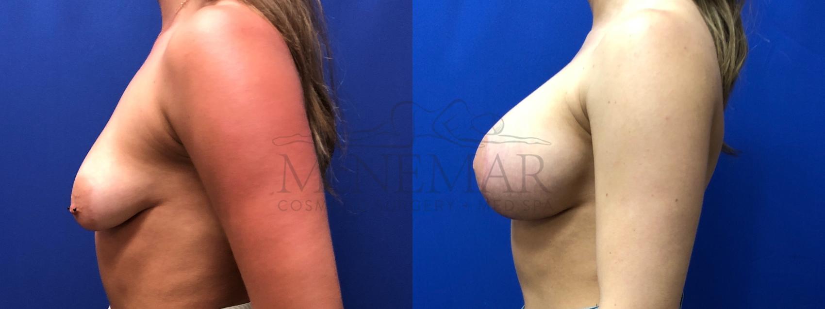 Breast Augmentation Case 128 Before & After Right Side | San Ramon & Tracy, CA | McNemar Cosmetic Surgery