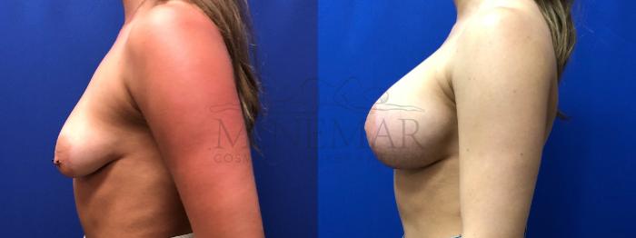 Breast Augmentation Case 128 Before & After Right Side | Tracy, Brentwood & Livermore, CA | McNemar Cosmetic Surgery