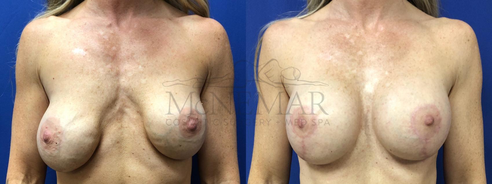 Breast Augmentation Case 130 Before & After Front | Tracy, Brentwood & Livermore, CA | McNemar Cosmetic Surgery