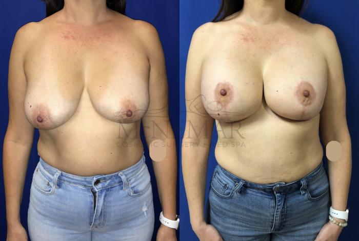 Breast Lift (Mastopexy) Case 148 Before & After Front | Tracy, Brentwood & Livermore, CA | McNemar Cosmetic Surgery