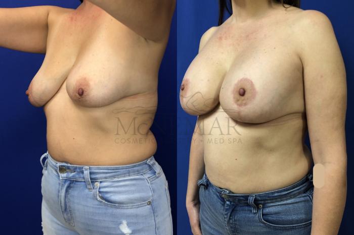 Breast Augmentation Case 148 Before & After Right Side | Tracy, Brentwood & Livermore, CA | McNemar Cosmetic Surgery