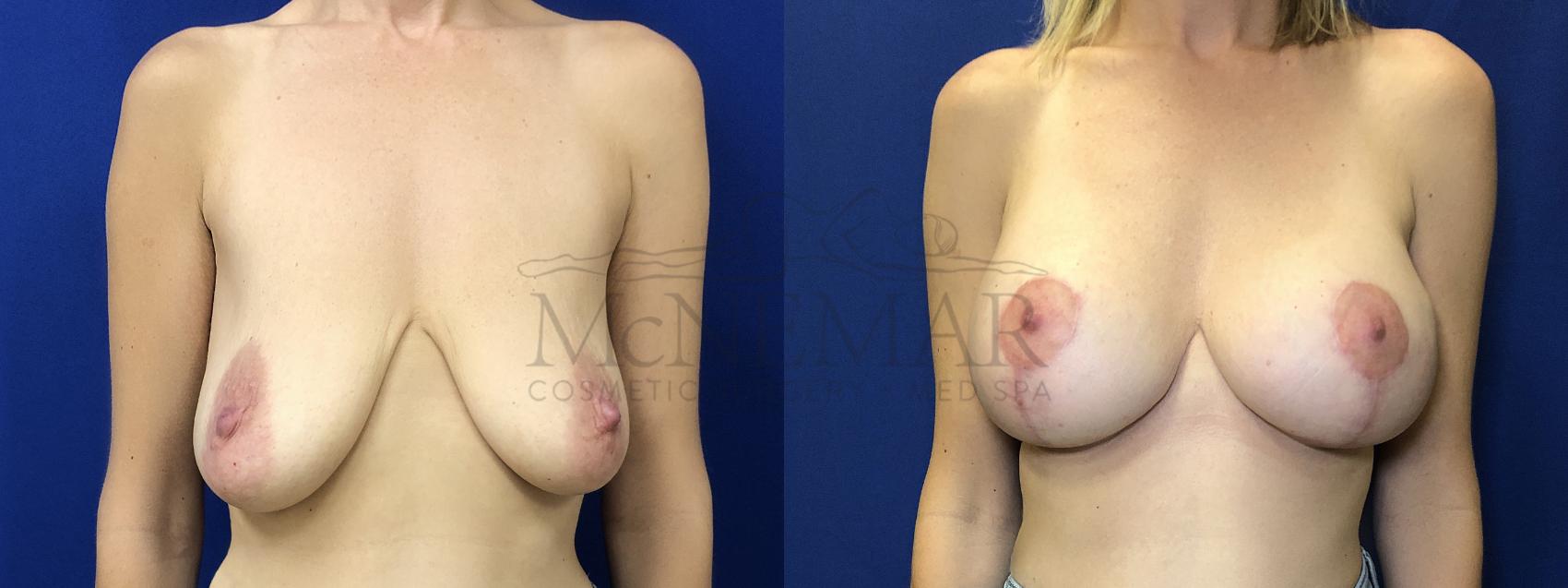 Breast Augmentation Case 156 Before & After Front | Tracy, Brentwood & Livermore, CA | McNemar Cosmetic Surgery