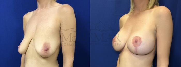 Breast Augmentation Case 156 Before & After Left Side | Tracy, Brentwood & Livermore, CA | McNemar Cosmetic Surgery