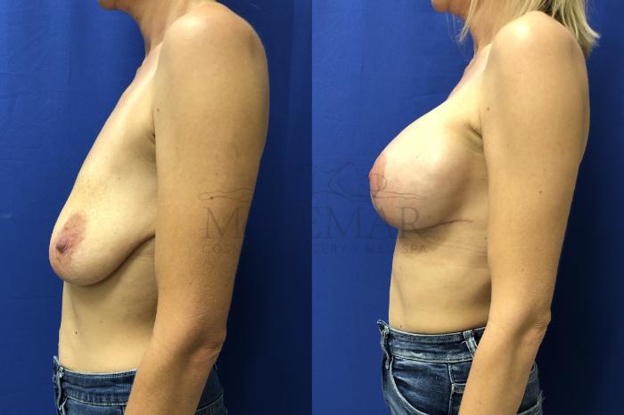 Breast Lift (Mastopexy) Case 156 Before & After Right Oblique | Tracy, Brentwood & Livermore, CA | McNemar Cosmetic Surgery